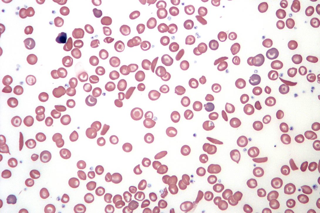 Sickle cells under a microscope.