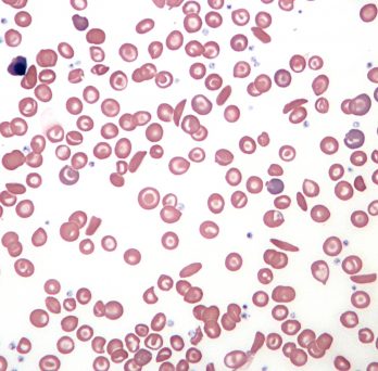 Sickle cells under a microscope. 